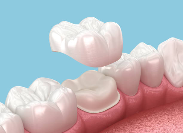 Computer image of a dental crown being placed on a shaved tooth.